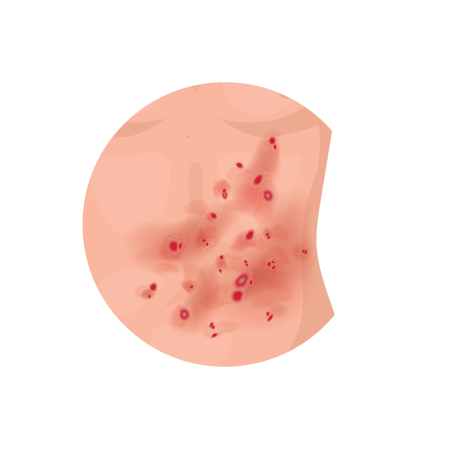 Guttate Psoriasis Thumbnail