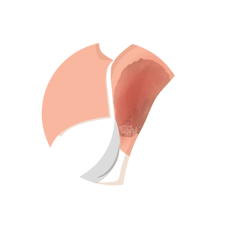 Inverse Psoriasis Thumbnail