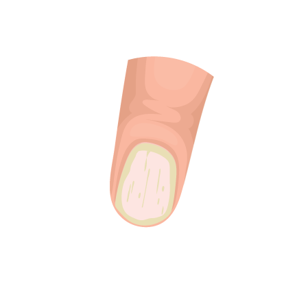 Nail Psoriasis Thumbnail