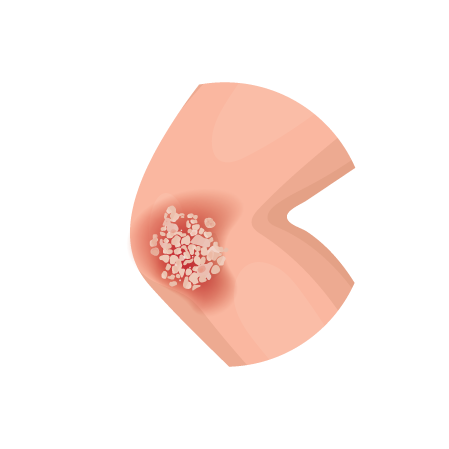Plaque Psoriasis Thumbnail