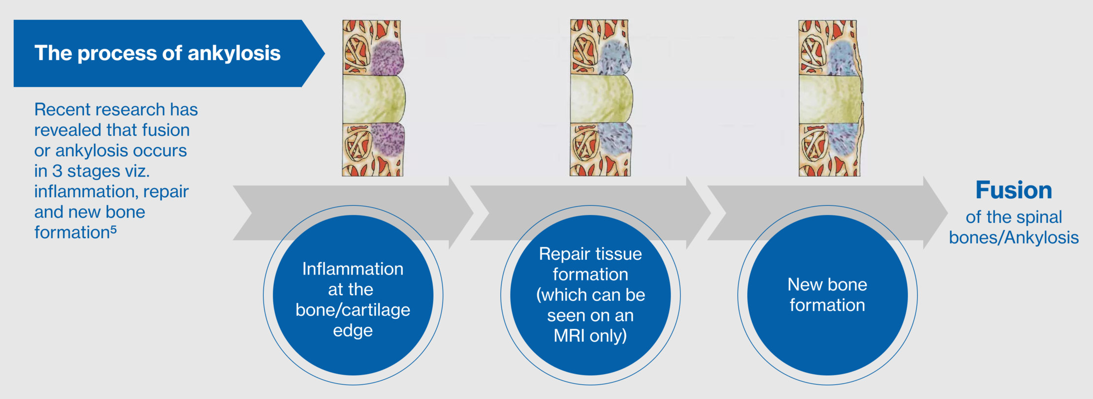 process-of-ankylosis_0