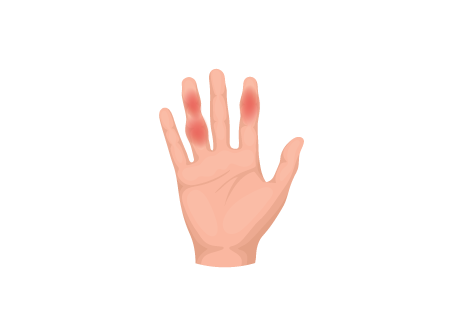 Psoriatic Arthritis Thumbnail