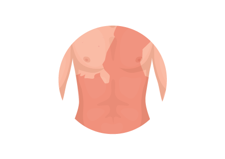 Erythrodermic Psoriasis Thumbnail