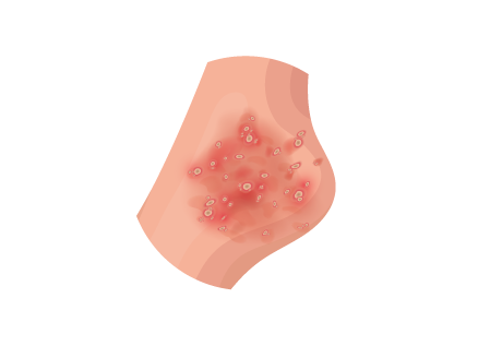Pustular Psoriasis Thumbnail